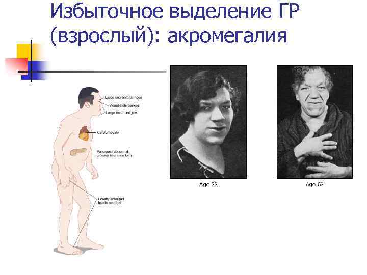 Избыточное выделение ГР (взрослый): акромегалия 