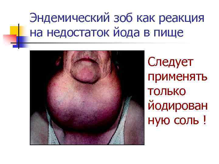 Эндемический зоб как реакция на недостаток йода в пище Следует применять только йодирован ную