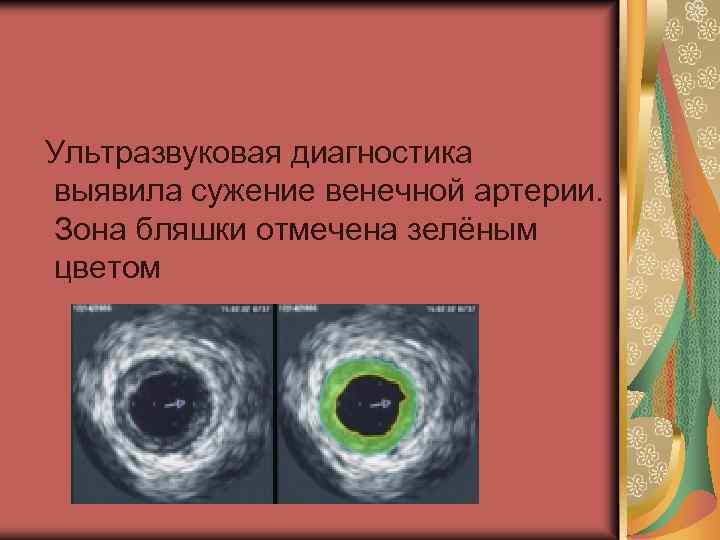  Ультразвуковая диагностика выявила сужение венечной артерии. Зона бляшки отмечена зелёным цветом 