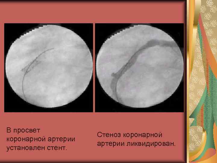  В просвет коронарной артерии установлен стент. Стеноз коронарной артерии ликвидирован. 