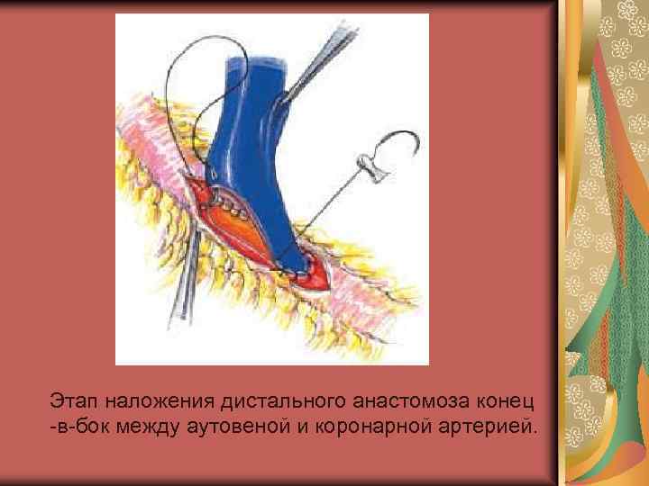  Этап наложения дистального анастомоза конец -в-бок между аутовеной и коронарной артерией. 