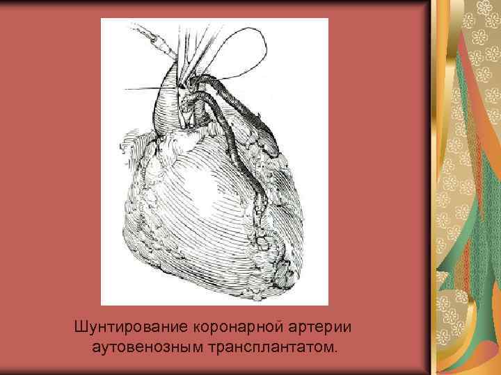 Шунтирование коронарной артерии аутовенозным трансплантатом. 
