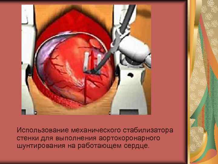  Использование механического стабилизатора стенки для выполнения аортокоронарного шунтирования на работающем сeрдце. 