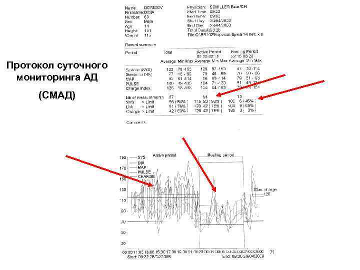 Протокол суточного мониторинга АД (СМАД) 