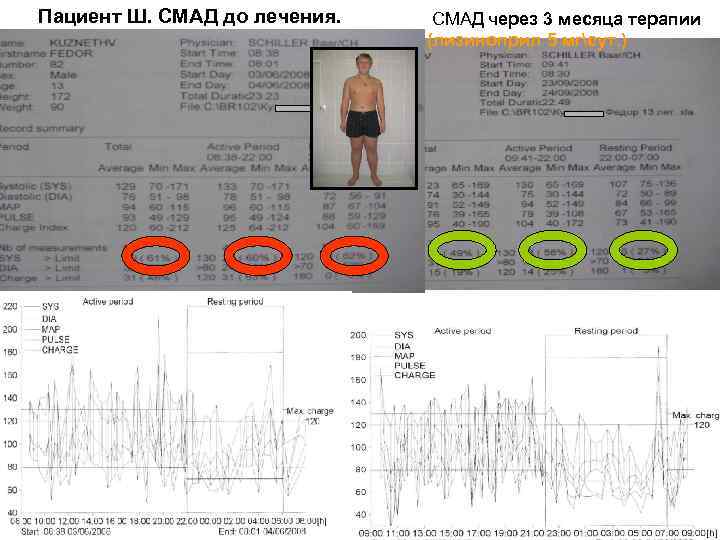 Пациент Ш. СМАД до лечения. СМАД через 3 месяца терапии (лизиноприл 5 мгсут. )