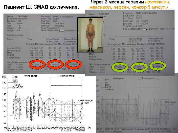 Пациент Ш. СМАД до лечения. Через 2 месяца терапии (кортексин, мексидол, персен, конкор 5