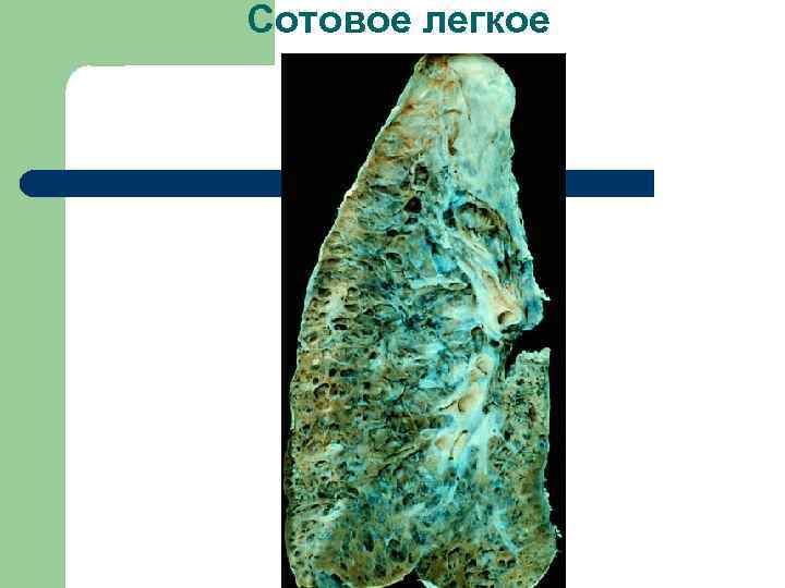 Сотовое легкое 