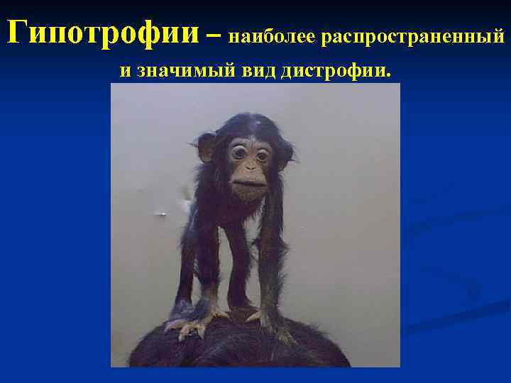 Гипотрофии – наиболее распространенный и значимый вид дистрофии. 