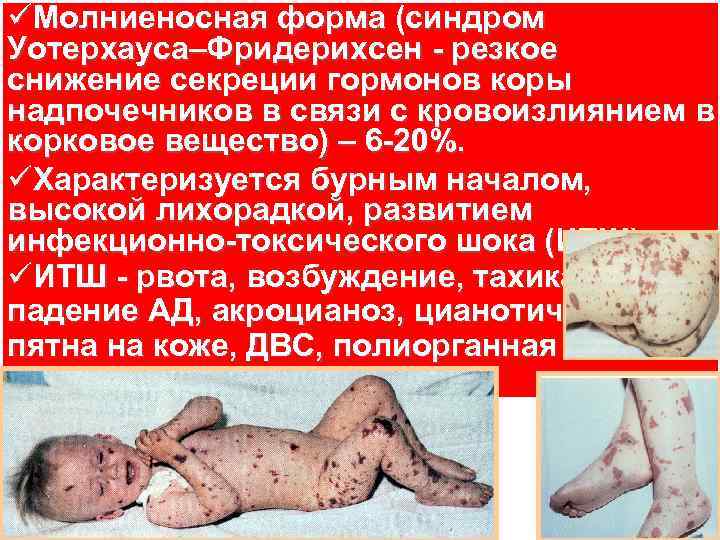 üМолниеносная форма (синдром Уотерхауса–Фридерихсен резкое снижение секреции гормонов коры надпочечников в связи с кровоизлиянием