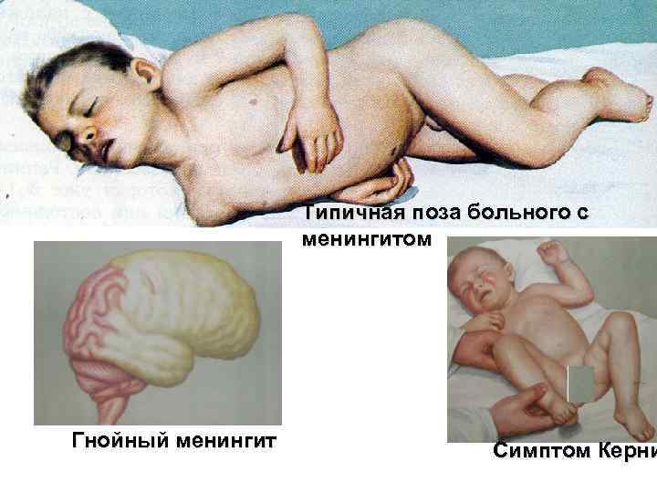 Типичная поза больного с менингитом Гнойный менингит Симптом Керни 