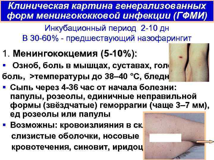 Клиническая картина генерализованных форм менингококковой инфекции (ГФМИ) Инкубационный период 2 -10 дн В 30