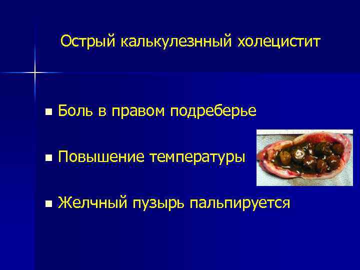 Острый калькулезнный холецистит n Боль в правом подреберье n Повышение температуры n Желчный пузырь