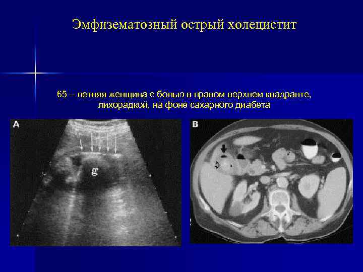 Эмфизематозный острый холецистит 65 – летняя женщина с болью в правом верхнем квадранте, лихорадкой,