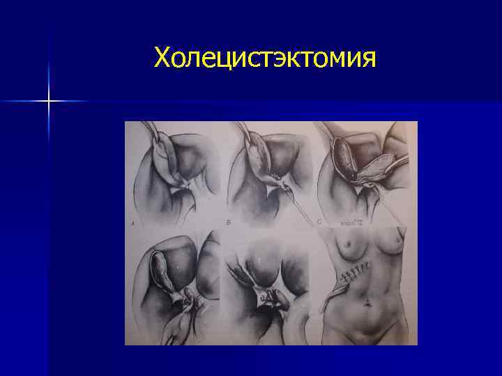 Холецистэктомия 