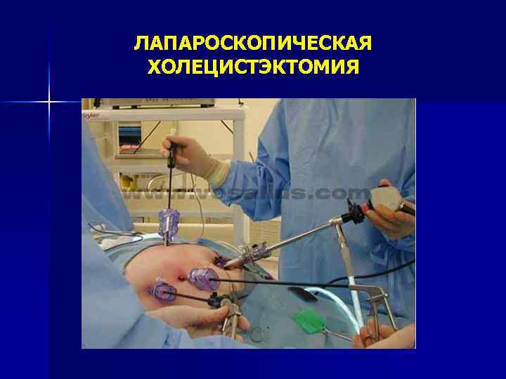 ЛАПАРОСКОПИЧЕСКАЯ ХОЛЕЦИСТЭКТОМИЯ 