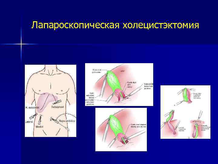 Карта вызова желчнокаменная болезнь