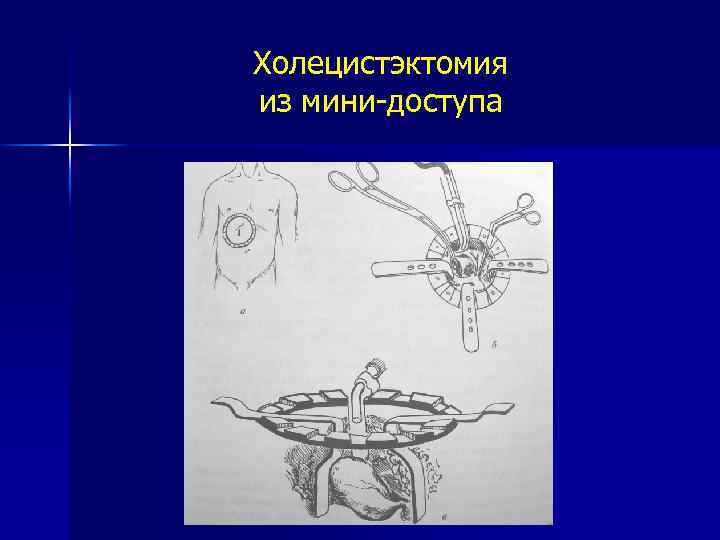 Холецистэктомия из мини-доступа 