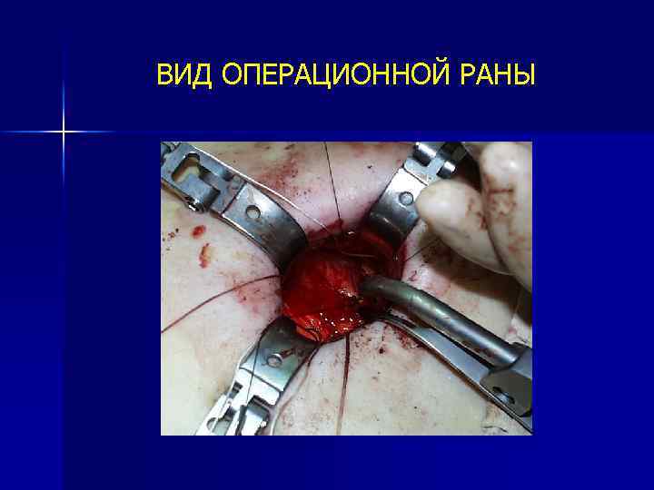 ВИД ОПЕРАЦИОННОЙ РАНЫ 