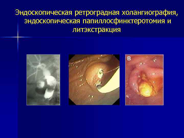 Эндоскопическая ретроградная холангиография, эндоскопическая папиллосфинктеротомия и литэкстракция 
