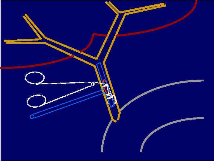 ХОЛЕДОХОЛИТОТОМИЯ ИЗ МИНИДОСТУПА (23 СЛУЧАЯ) 