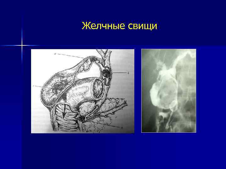 Желчные свищи 