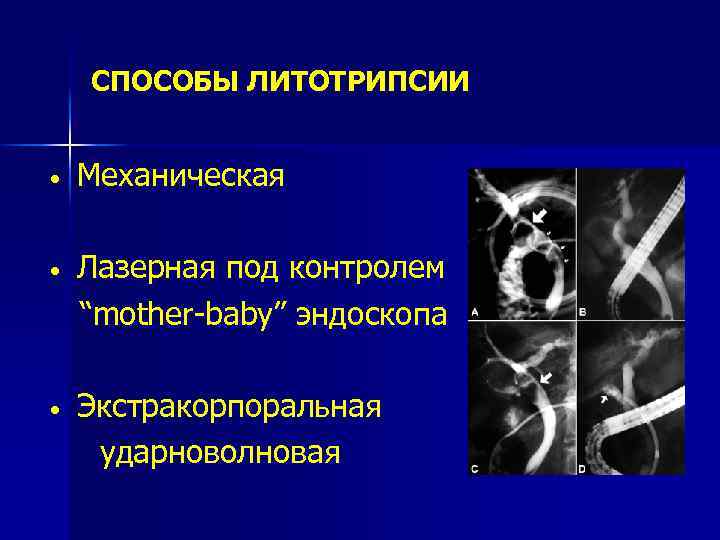 СПОСОБЫ ЛИТОТРИПСИИ • Механическая Лазерная под контролем “mother-baby” эндоскопа • Экстракорпоральная ударноволновая • 