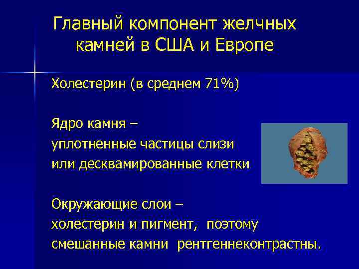 Главный компонент желчных камней в США и Европе Холестерин (в среднем 71%) Ядро камня