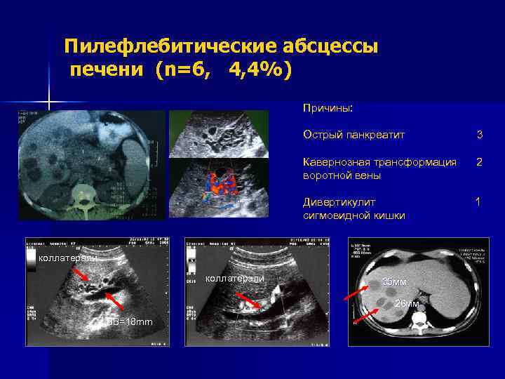 Пилефлебитические абсцессы печени (n=6, 4, 4%) Причины: Острый панкреатит 3 Кавернозная трансформация воротной вены