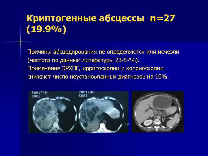 Криптогенные абсцессы n=27 (19. 9%) Причины абсцедирования не определяются или исчезли (частота по данным
