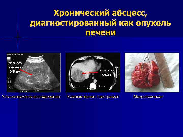 Хронический абсцесс, диагностированный как опухоль печени абсцесс печени 9. 5 см Ультразвуковое исследование абсцесс