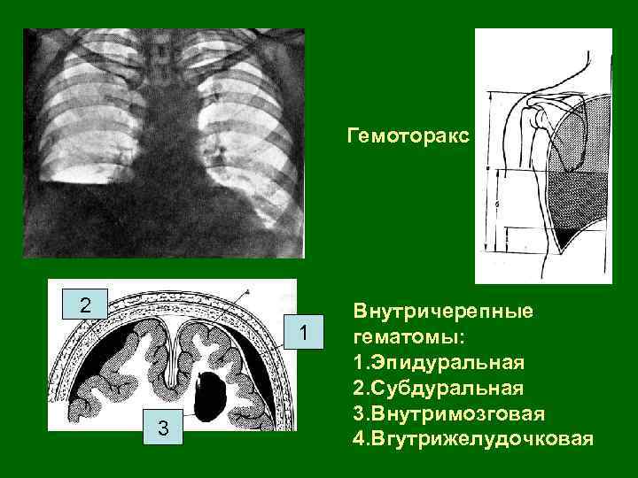 Гемоторакс 2 1 3 Внутричерепные гематомы: 1. Эпидуральная 2. Субдуральная 3. Внутримозговая 4. Вгутрижелудочковая