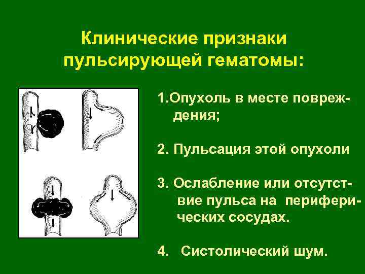 ПРИЗНАКИ Клинические признаки пульсирующей гематомы: 1. Опухоль в месте повреждения; 2. Пульсация этой опухоли