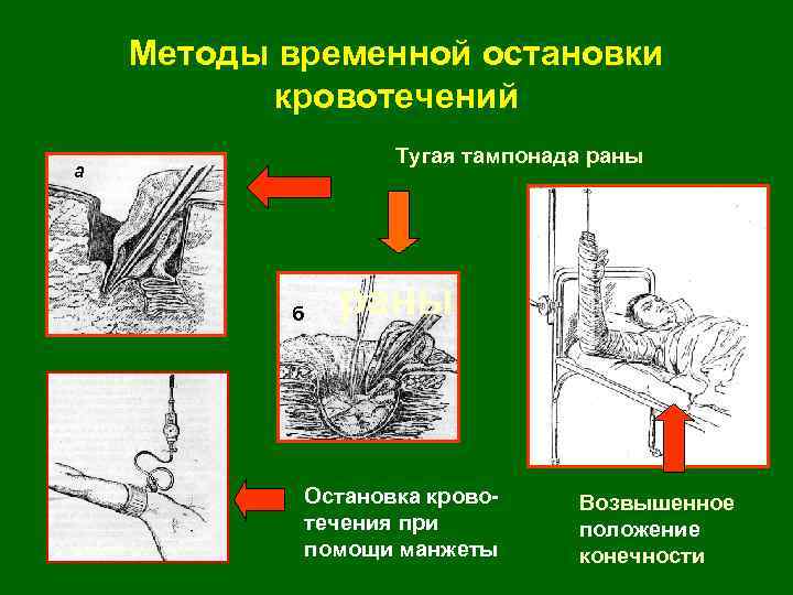 Методы временной остановки кровотечений Тугая тампонада раны а б раны Остановка кровотечения при помощи