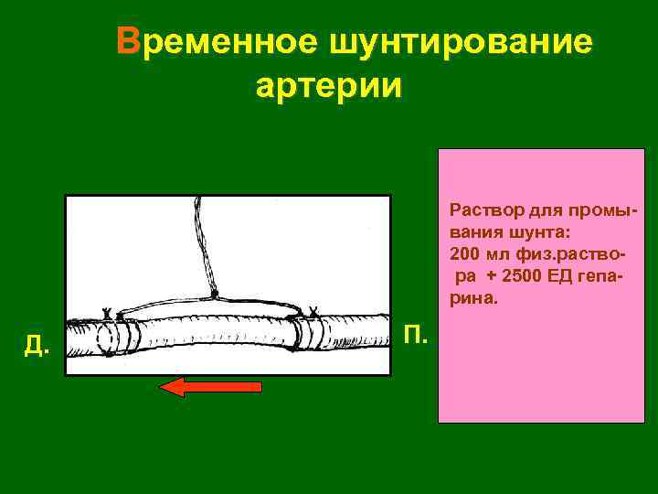 Временное шунтирование артерии Раствор для промывания шунта: 200 мл физ. раствора + 2500 ЕД