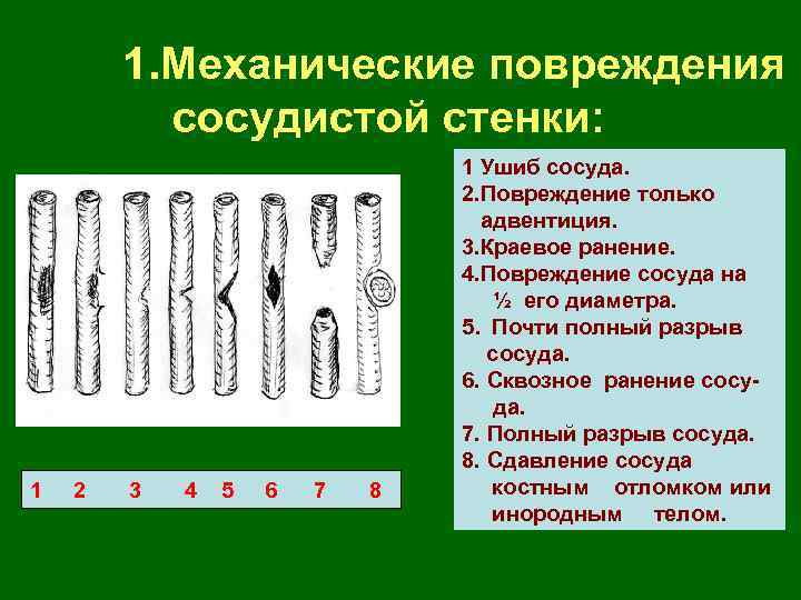 1. Механические повреждения сосудистой стенки: 1 2 3 4 5 6 7 8 1