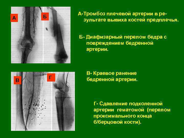 А А-Тромбоз плечевой артерии в результате вывиха костей предплечья. Б Б- Диафизарный перелом бедра