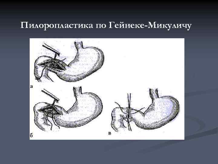 Пилоропластика по финнею схема