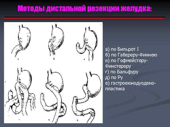 Бильрот модификации гофмейстера финстерера