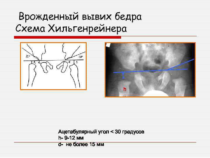 Врожденный вывих бедра презентация травматология