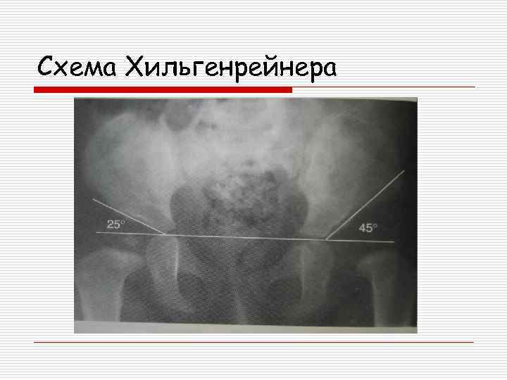 Схема хильгенрейнера тазобедренных суставов у детей