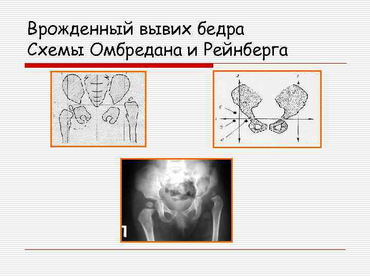 Схема врожденного вывиха бедра