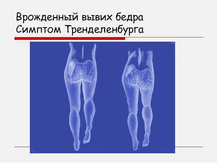 Схема врожденного вывиха бедра