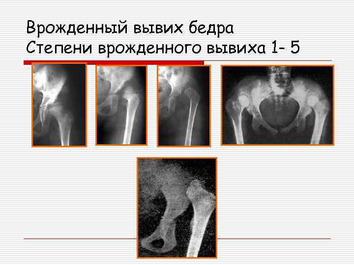 Врожденный вывих бедра презентация