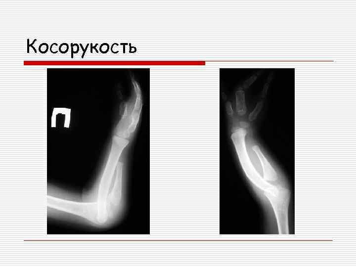 Псп в ортопедии что это