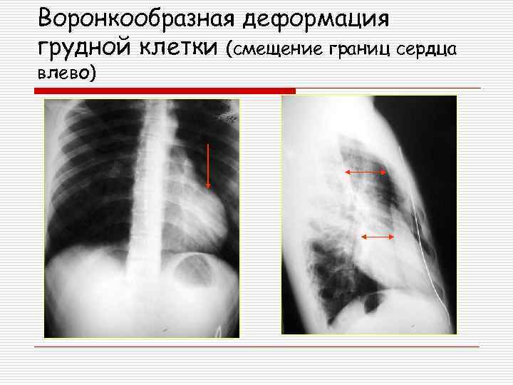 Смещение сердца влево