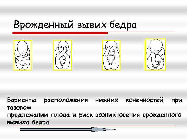 Врожденный вывих бедра Варианты расположения нижних конечностей при тазовом предлежании плода и риск возникновения