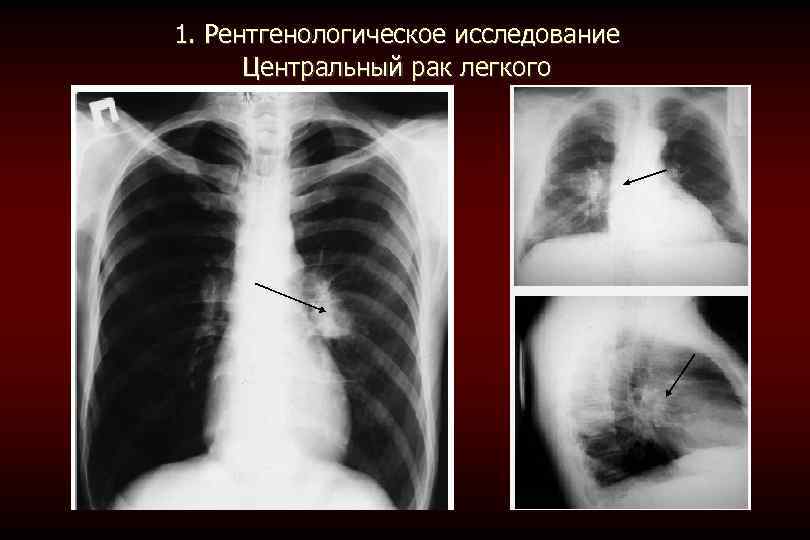 Центральный рак. Рентгенологическая картина центрального рака.. Рентгенологические признаки центральноогорака легкого. Рентгенологически исследования лёгких. Перибронхиальная опухоль легкого с распадом.