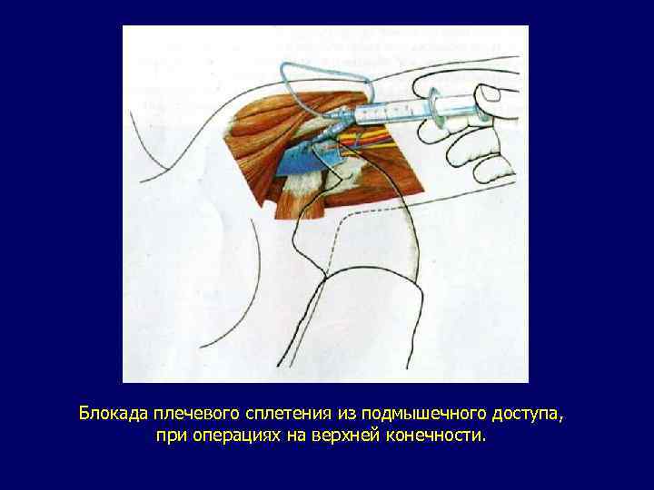 Блокада плечевого сплетения из подмышечного доступа, при операциях на верхней конечности. 