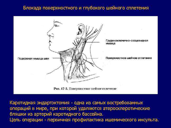 Блокада поверхностного и глубокого шейного сплетения Каротидная эндартэктомия - одна из самых востребованных операций