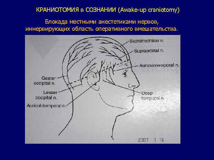 КРАНИОТОМИЯ в СОЗНАНИИ (Awake-up craniotomy) Блокада местными анестетиками нервов, иннервирующих область оперативного вмешательства. 